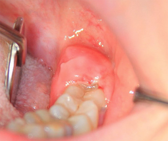 Dente do siso retido (escondido sob o capuz gengival)