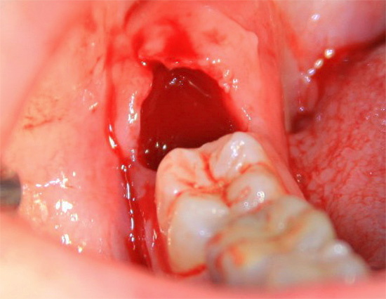 E é assim que um buraco novo se parece com a remoção de um dente do siso