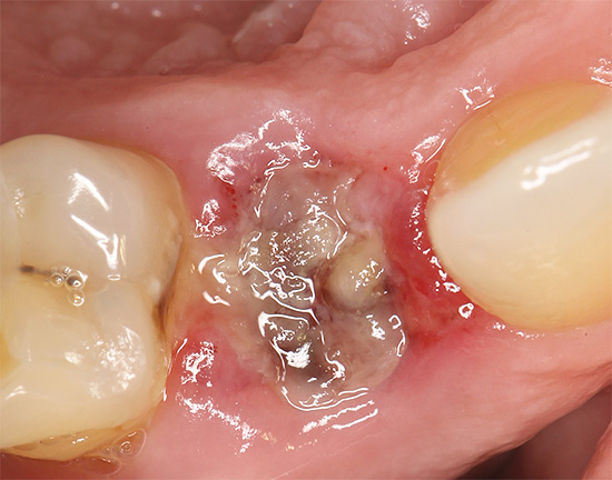 A fotografia mostra a aparência do orifício 2 dias após a extração do dente.
