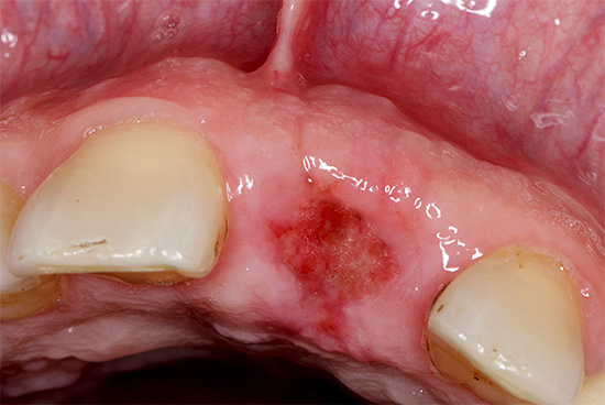 A aparência do buraco após 3 semanas a partir do momento da extração do dente - a gengiva praticamente cicatrizou.