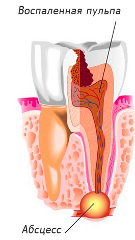 Exemplo esquemático de um cisto na raiz de um dente