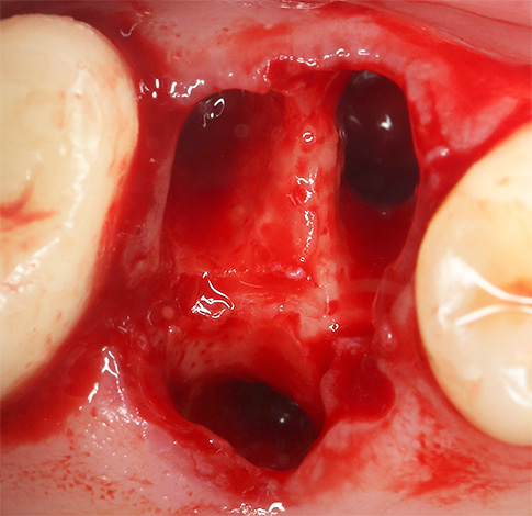Vamos falar sobre alguns pontos importantes sobre a parada do sangue após um procedimento de extração dentária ...