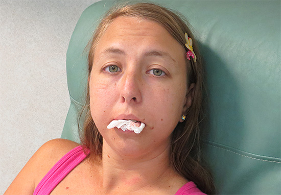 A maneira mais fácil de parar o sangramento é apertar firmemente um cotonete de gaze entre os dentes (ou gengivas).