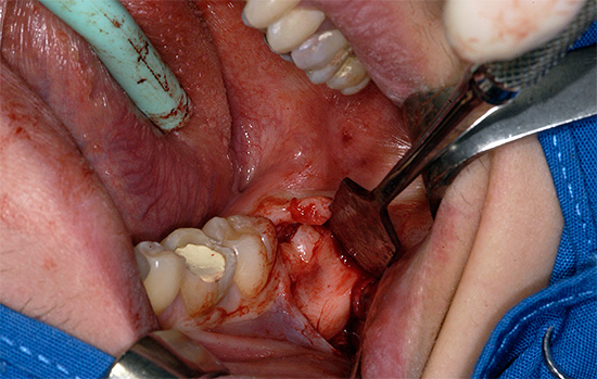 A foto mostra a remoção de um dente do siso com dissecção preliminar das gengivas.