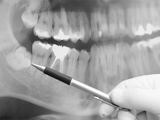 A remoção dos dentes do siso devido à sua localização não padrão na mandíbula é considerada uma operação de maior complexidade.