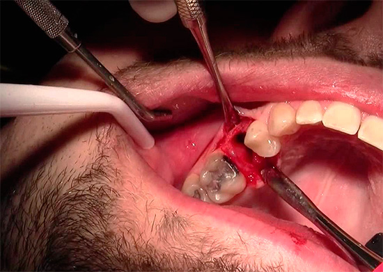 O sangramento pode se intensificar se o médico for forçado a abrir a ferida muito ampla para melhor acesso às raízes do dente.
