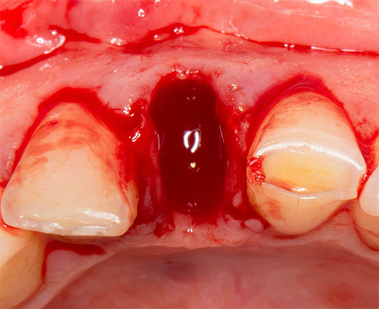 Muitas vezes, há situações em que uma pessoa, tendo chegado em casa de um dentista-cirurgião, descobre que o sangue não deseja parar e o orifício no local do dente extraído continua sangrando algumas vezes por horas.