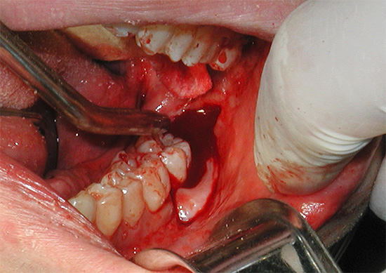 Às vezes, durante a extração dentária, o médico danifica seriamente o tecido da gengiva, o que também contribui para o sangramento.