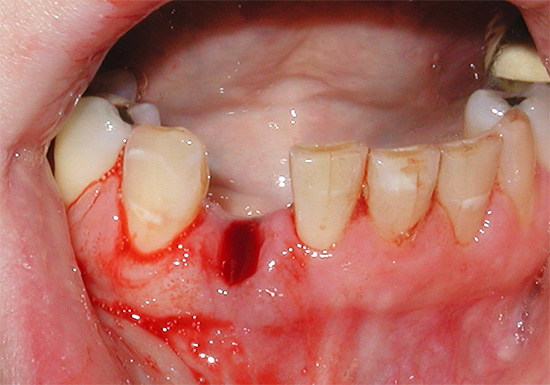 Normalmente, o sangramento após a extração do dente deve parar após 10 a 30 minutos.