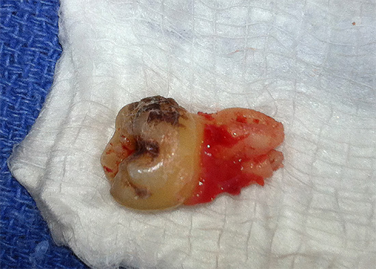 Existem várias maneiras eficazes de parar o sangue por conta própria após o procedimento de extração do dente.