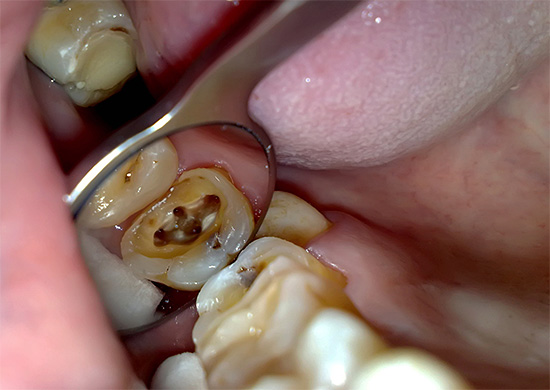 Dente a quattro canali