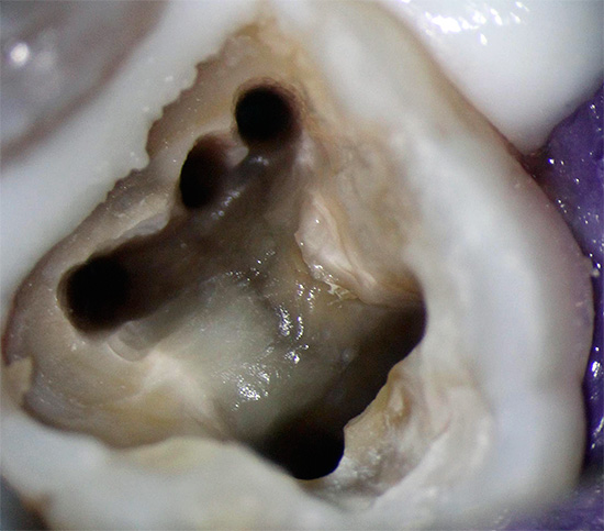 Dente a cinque canali
