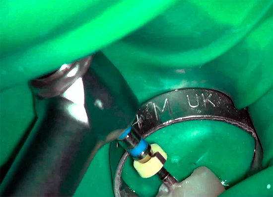 Più canali ci sono nel dente, più il medico deve eseguire operazioni durante il suo trattamento ...