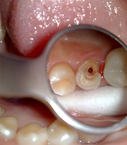 La foto mostra il trattamento della pulpite di un dente a canale singolo.