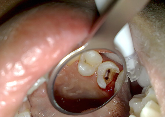 E questo è un dente a due canali.