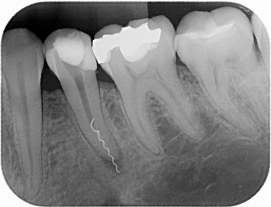 L'immagine mostra chiaramente un pezzo di uno strumento dentale rotto nel canale dentale.