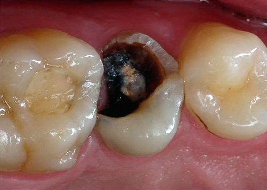 Non sperare che con la polpite il dolore scompaia da solo, perché anche se ciò accade, la polpa marcirà nel dente.