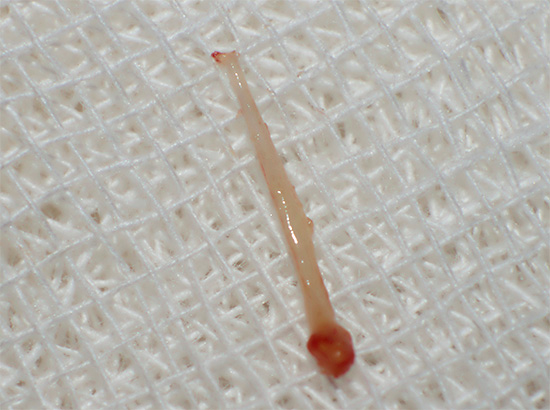 Un'altra fotografia della polpa dentale: nel trattamento della pulpite di un dente a tre canali, è necessario rimuovere un nervo da ciascun canale.