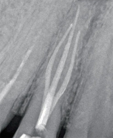 La radiografia del dente consente di controllare la qualità del riempimento di ciascuno dei canali dentali.