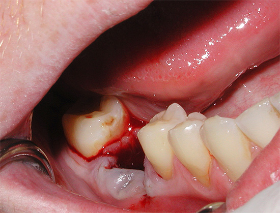 Depois que um dente é arrancado, a bochecha incha com muita frequência, mas é difícil para uma pessoa comum entender por si mesma se isso é normal ou, por outro lado, perigoso para a saúde.