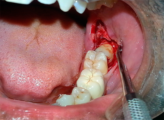 Como resultado de uma lesão nos tecidos moles e duros, um processo inflamatório e edema se desenvolvem próximo ao dente removido.