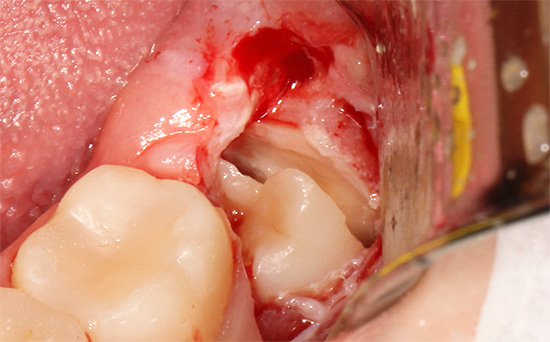 A foto mostra um exemplo de uma remoção complexa de um dente do siso quando ele é retirado literalmente por partes de um buraco.