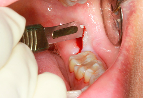 Quando você remove o dente do siso retardado, a gengiva sob a qual está localizado é primeiro cortada.
