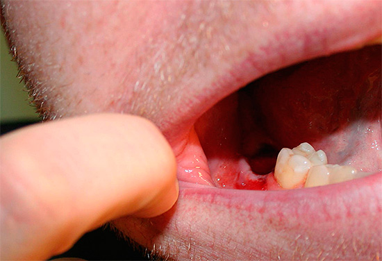 Se você consultou um médico após remover um dente para obter ajuda repetida, provavelmente, além de um exame externo, também será necessária uma radiografia do orifício.