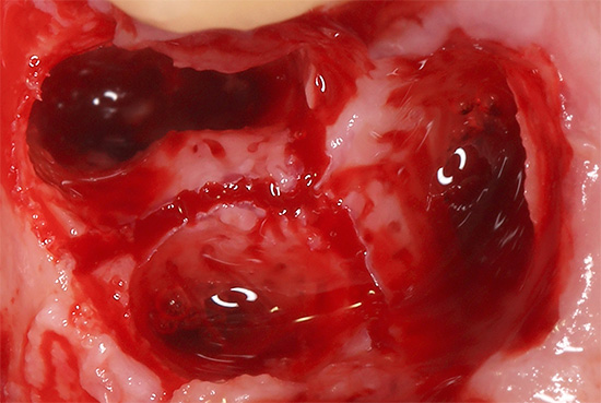 A extração dentária está sempre associada a traumas nos tecidos circundantes, tornando-os naturalmente inflamados.