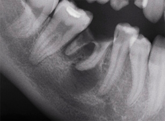 É assim que a periodontite se parece em um raio-x (radiografia)