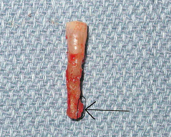 A foto mostra um dente com um cisto na raiz.