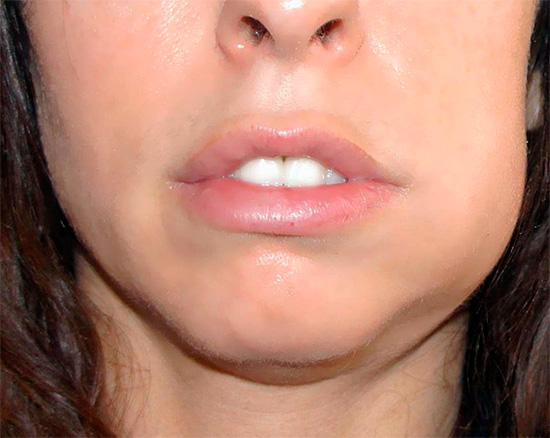 Muitas vezes, após a extração do dente, a temperatura sobe naquele dia (geralmente no final da tarde).
