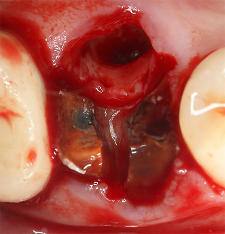 Se o médico erroneamente não extrair pelo menos um pedaço da raiz do dente do buraco, um cisto pode se formar ao redor dele.