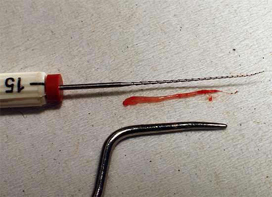 Conosciamo le caratteristiche e le sfumature interessanti della procedura per rimuovere un nervo da un dente ...