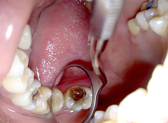 Considera i passaggi principali che compongono la procedura per rimuovere un nervo da un dente.