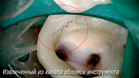 La foto mostra un pezzo di un frammento di uno strumento dentale estratto da un canale.