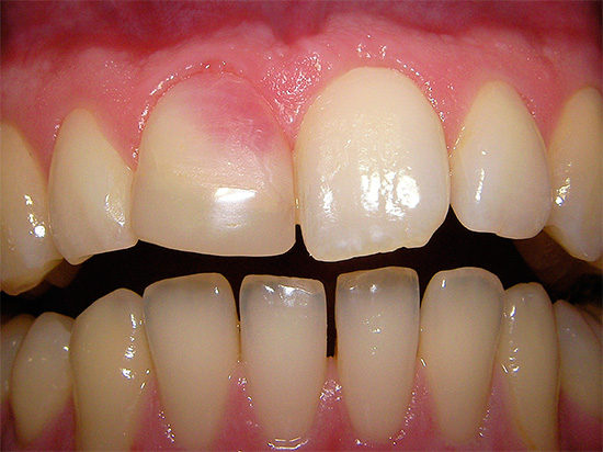 Ed ecco un esempio di un dente rosa, il cui colore è apparso a causa dell'uso della pasta di resorcinolo-formalina nel trattamento del canale.