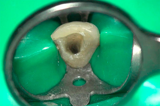 Di norma, il prezzo minimo si ottiene solo nel trattamento della pulpite di un dente a canale singolo.