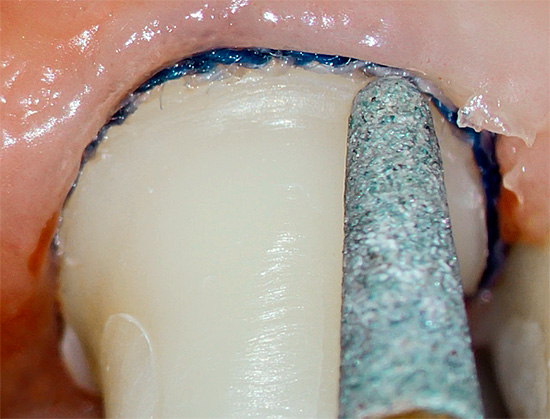 Durante la rettifica del dente sotto la corona, il nervo al suo interno può surriscaldarsi, il che porterà successivamente alla pulpite.