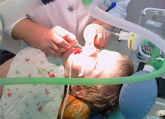 O tubo de respiração e outros itens de equipamento às vezes interferem com o médico realizando manipulações na cavidade oral do paciente.