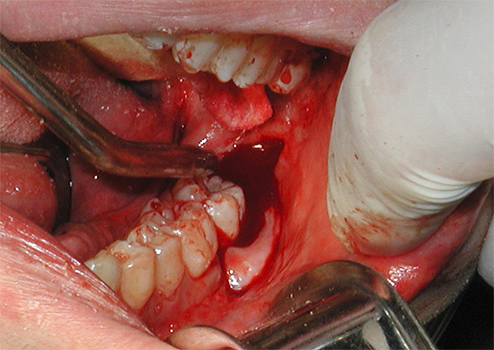 A vantagem da anestesia é a possibilidade de manipulações longas e traumáticas sem dor, por exemplo, associadas à remoção complexa de um dente do siso.