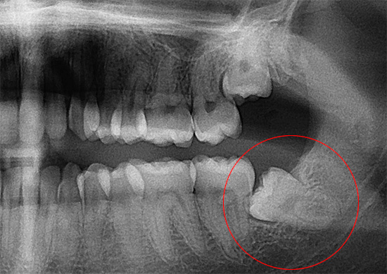 Nesse raio-x, um dente do siso localizado incorretamente na mandíbula é claramente visível.