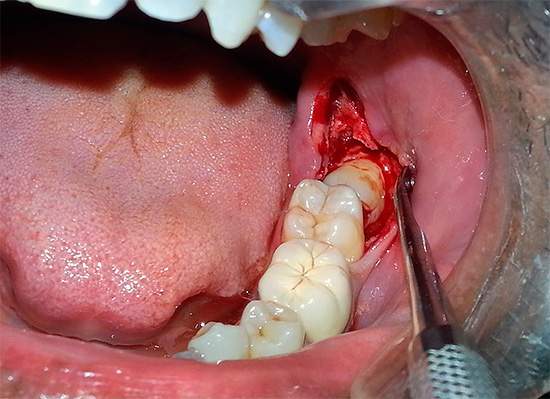 Se a anestesia for contra-indicada, você terá que remover o dente da maneira antiga - usando anestesia local.