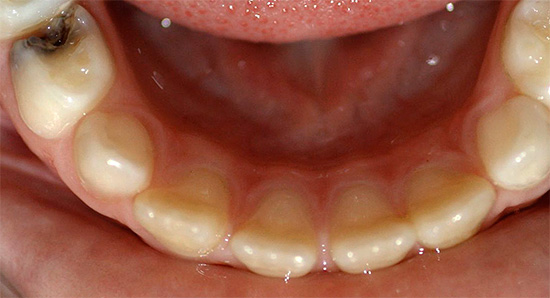 Nella maggior parte dei casi, la pulite si verifica a causa dell'infezione della polpa da parte di batteri che penetrano all'interno del dente attraverso la carie cavità.