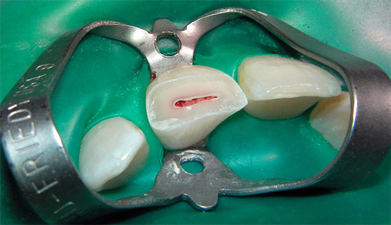 La foto mostra un dente rotto, in cui la camera della polpa è chiaramente visibile ...