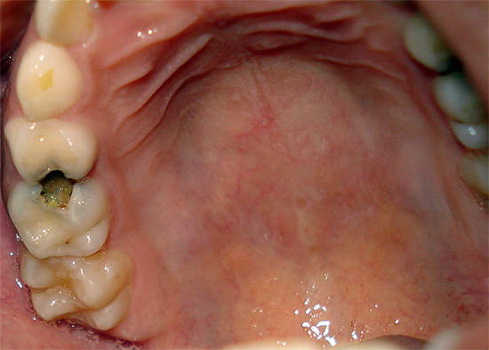 No caso de dor de dente aguda (por exemplo, com pulpite), tomar No-Shpa será inútil.