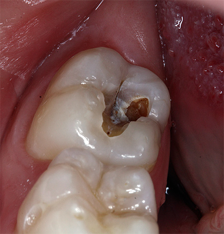 Às vezes, o No-Shpu é aplicado diretamente a um dente doente ou mesmo colocado em uma cárie - e isso às vezes reduz a dor.