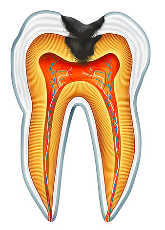 Quando aplicado topicamente, o medicamento funciona apenas nos casos em que exista uma mensagem entre a cavidade cariosa do dente e a câmara pulpar.
