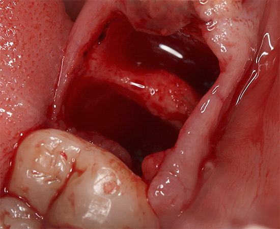 La conseguenza della rimozione di qualsiasi dente può essere un sanguinamento prolungato dal foro ...
