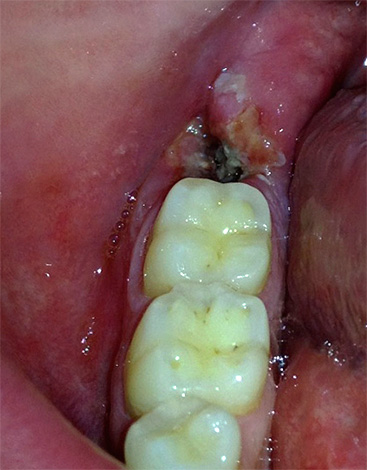 Un aumento della temperatura può anche indicare una grave infiammazione dell'incavo del dente.